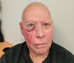 Tony's Eye Injury